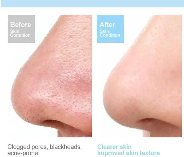 Alt view image 6 of 7 - Prospera DL009 Hot Compress red blue light cleansing massager