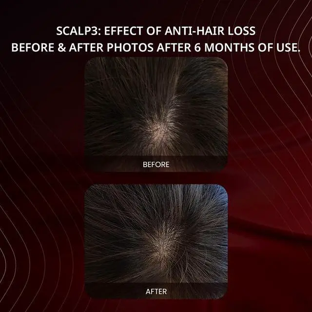 Alt view image 4 of 7 - Breo Scalp3 Scalp Massager Comb Anti Hair Loss Scalp Massaging brush Hair Growth Care Scalp Hair Therapy Scalp Reduction Redlight Infrared Therapy Head Massager Grey