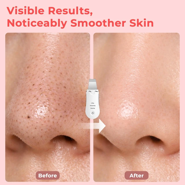 Alt view image 3 of 7 - YEVYO Skin Scrubber Face Spatula, Ultrasonic Skin Scrubber for Deep Cleansing and Blackhead Removal, Facial Spatula, Pore Cleaner at Home and Travel