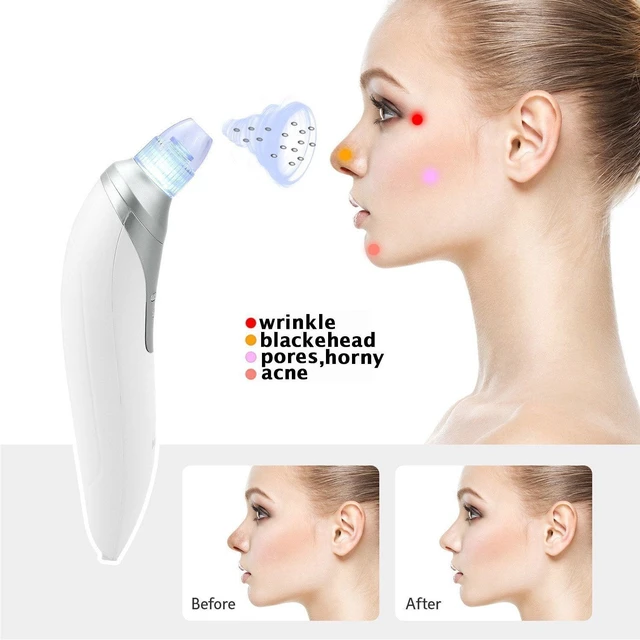 Alt view image 7 of 7 - Facial Pore Blackhead Remover - Face Cleaner and Blackhead Extractor with 4 Suction Heads