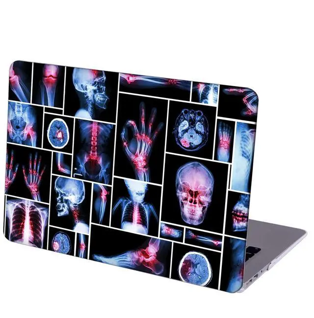 Main image of MINGDAO Case Compatible with MacBook Air 13 inch Retina Display with Touch ID, Hard Protective Shell with Keyboard Cover (M1 A2337 A2179 A1932, 2018 2019 2020 Release) - X-Ray Human Skeleton-2