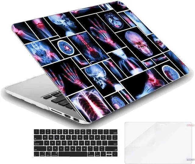 Alt view image 2 of 5 - MINGDAO Case Compatible with MacBook Air 13 inch Retina Display with Touch ID, Hard Protective Shell with Keyboard Cover (M1 A2337 A2179 A1932, 2018 2019 2020 Release) - X-Ray Human Skeleton-2
