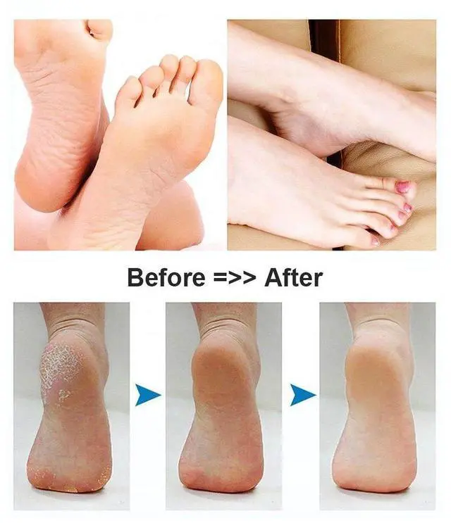 Alt view image 3 of 6 - Foot Scrubber Electric Callus Remover Rechargeable Foot File Hard Skin Remover Pedicure Tools Electronic Callus kit for Cracked Heels and Dead Skin with 2 Roller Heads, Blue