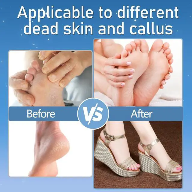 Alt view image 4 of 7 - _Mega Brand Callus Remover for Feet, Electric Foot Callus Remover Waterproof with 3 Rollers 2 Speed Battery Display,17 in1 Rechargeable Foot File Pedicure Kits for Dead Hard Cracked Dry Skin