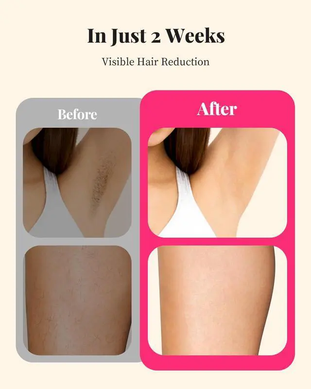 Alt view image 3 of 7 - Laser Hair Removal for Women and Men, At-Home IPL Hair Removal Device with 5.2 cm² Treatment Window, Nearly Painless, Visible Results in 2 Weeks, Full Body Treatment in 8 Minutes