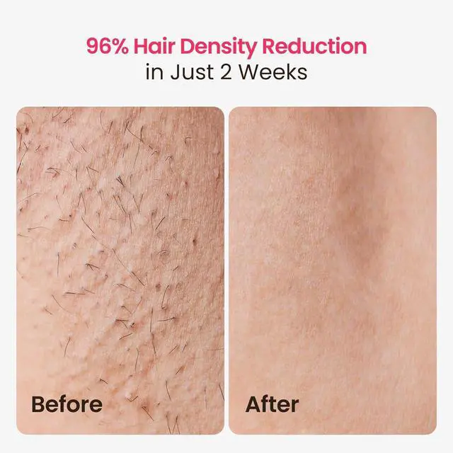 Alt view image 3 of 7 - IPL Laser Hair Removal for Women and Men, 25J Triple-Pulse Permanent Hair Removal Device for Ingrown & Coarse Hair, 37°F Painless Sapphire Ice Cooling Hair Removal for Legs, Facial, Armpits, Bikini