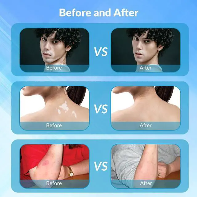 Alt view image 5 of 7 - ZJKC 6Diodes 308nm Excimer Blue Uvb Light therapy device for Skin Deseases Treatment