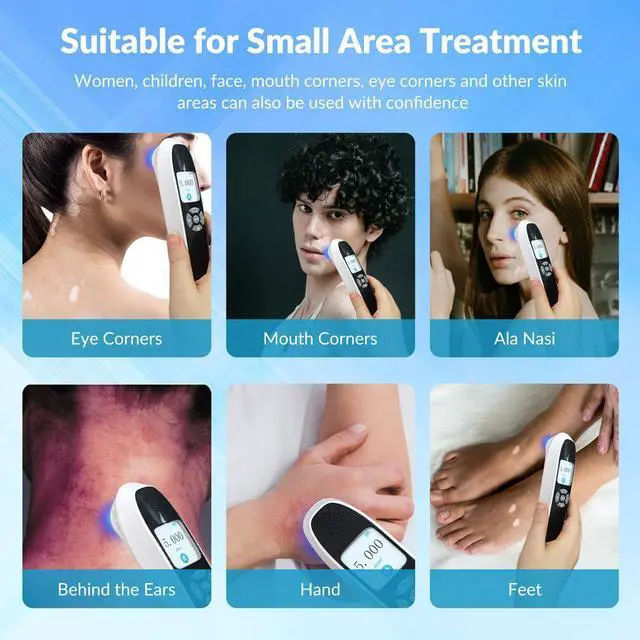 Alt view image 4 of 7 - ZJKC 6Diodes 308nm Excimer Blue Uvb Light therapy device for Skin Deseases Treatment