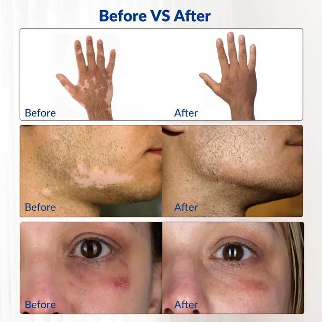 Alt view image 5 of 7 - ZJKC Touchscreen 49 Diodes Cold Laser Therapy Device For Pain Relief 650/808nm 905nm 980nm