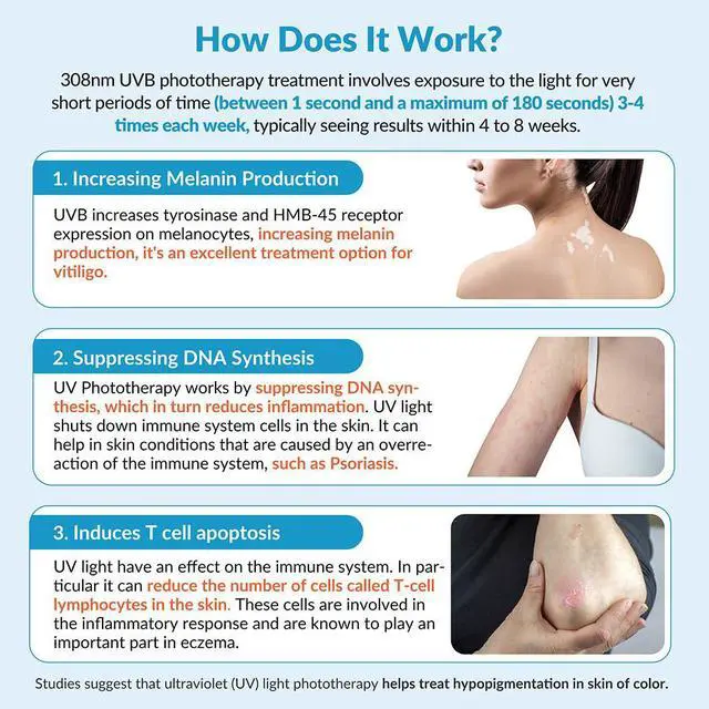 Alt view image 2 of 6 - ZJKC 308nm Skin Desease Treatment Blue Uv Light Therapy Device Home Use 45mW/cm2