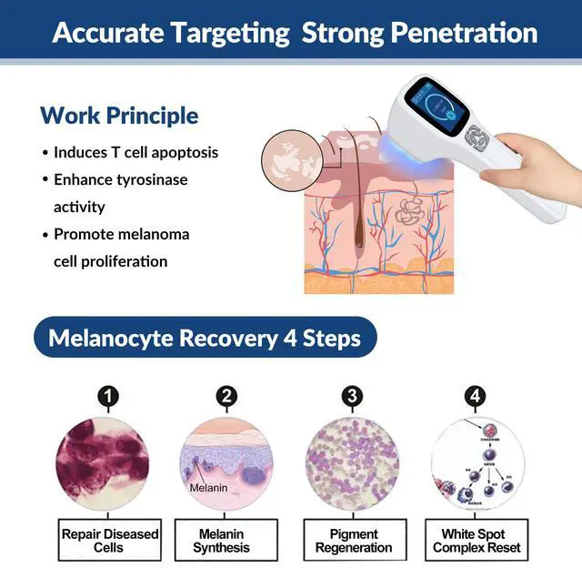 Alt view image 2 of 7 - ZJKC 308nm Excimer Blue Light Therapy Phototherapy for Skin Diseases Device
