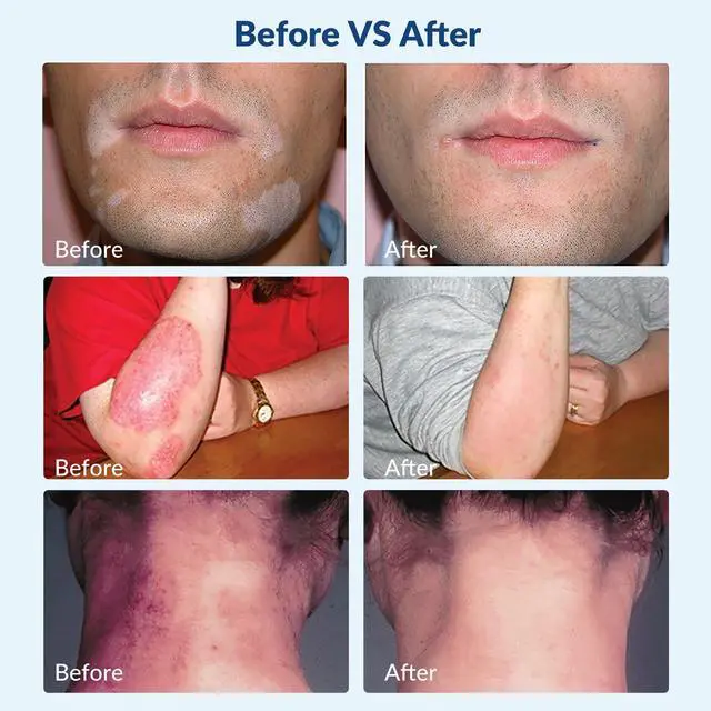 Alt view image 3 of 7 - ZJKC 308nm Excimer UVB Light Therapy Device for Skin Diseases Treatment 49 Diodes