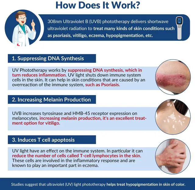 Alt view image 2 of 7 - ZJKC UVB Light 64pcs 308nm Wavelength UVB Narrowband Blue Light Therapy Device