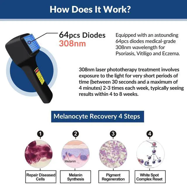 Alt view image 2 of 7 - ZJKC 308nm Ultraviolet Light Treatment for Treatment UVB Lamp Phototherapy Device.