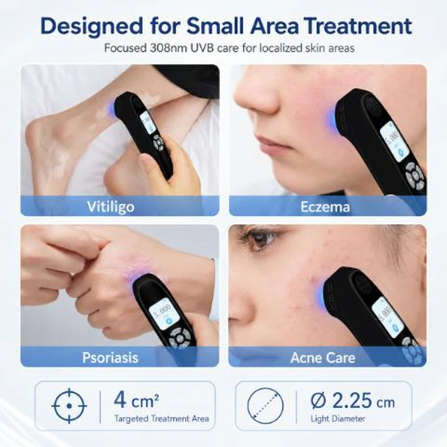 Alt view image 4 of 7 - ZJKC 308nm UVB Light Therapy Device 20mW/cm² for Psoriasis Vitiligo Eczema Portable Rechargeable LCD Home Phototherapy