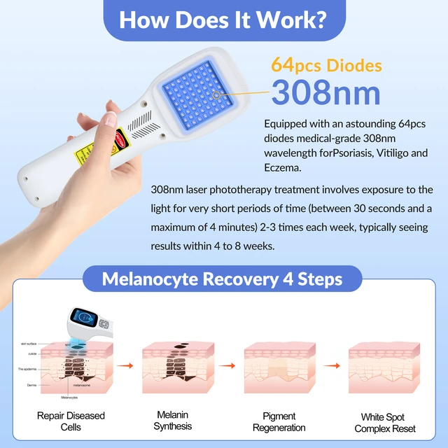 Alt view image 5 of 7 - ZJZKTOP 308nm UVB Phototherapy Device for Psoriasis Vitiligo, UVB Light Therapy Machine, 64 Diodes, 5-50mW/cm2 Adjustable Intensity, Ultraviolet Therapy Lamp with LCD Screen