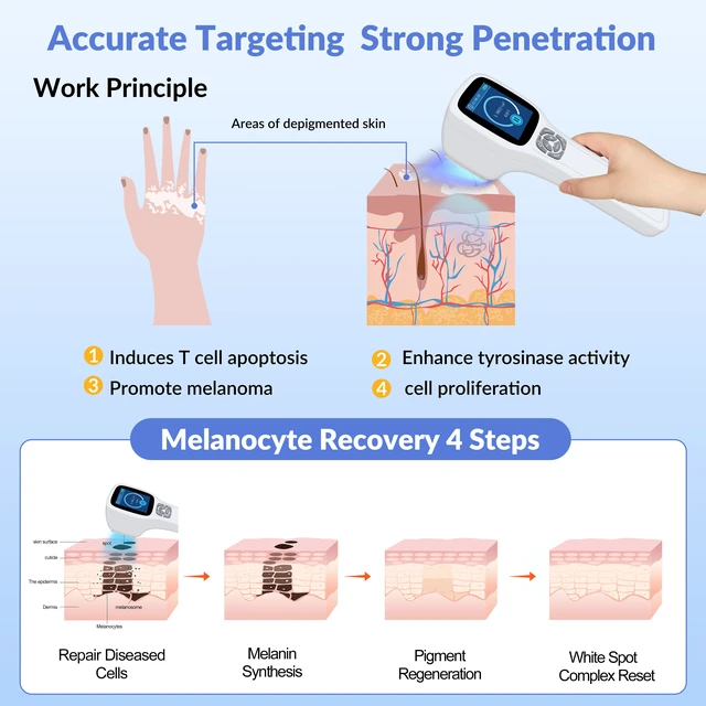 Alt view image 2 of 7 - ZJZKTOP 308nm UVB Light Therapy for Psoriasis and Vitiligo, Narrowband UVB Phototherapy Device, 64 Diodes, Adjustable 5-50mW/cm2, Handheld Ultraviolet Therapy Lamp with MED Test