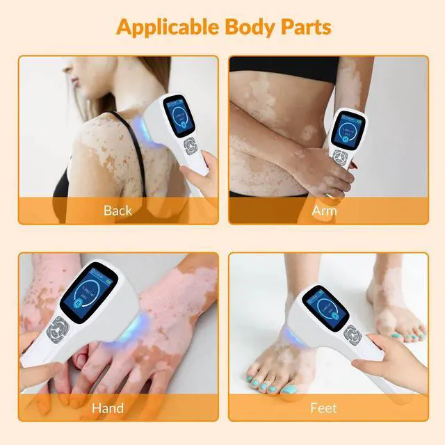 Alt view image 3 of 7 - Toponechoice 308nm Excimer Light High-intensity Ultraviolet Light for Skin Treatment 0-5J/cm2