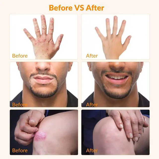 Alt view image 4 of 7 - Toponechoice 308nm Excimer Light High-intensity Ultraviolet Light for Skin Treatment 0-5J/cm2