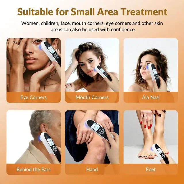 Alt view image 4 of 7 - Toponechoice Upgraded UVB Light Therapy Device, 308nm with Timer for Face/Body 0-5J/cm²