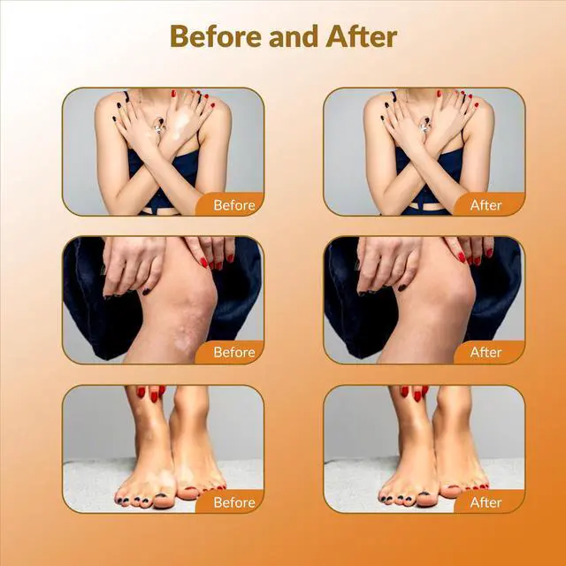 Alt view image 5 of 7 - Toponechoice Upgraded UVB Light Therapy Device, 308nm with Timer for Face/Body 0-5J/cm²