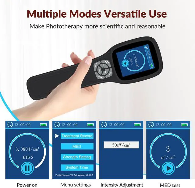 Main image of Toponechoice uvb light treatment psoriasis white discoloration on nails, at back of throat, white spots on skin after sun