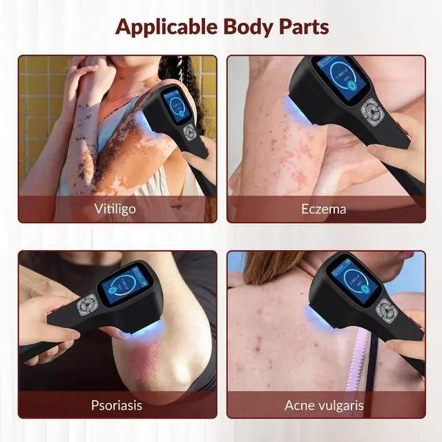 Main image of Toponechoice phototherapy uvb light, ultraviolet light to treat psoriasis white marks on toenails, skin, stool with white spots