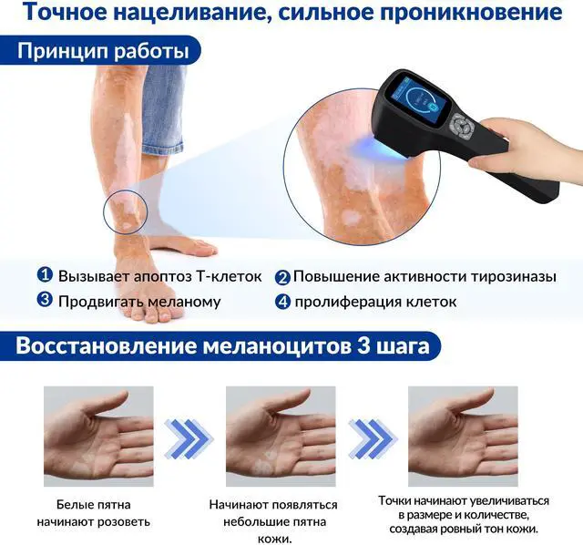 Alt view image 4 of 7 - Toponechoice uv light therapy for wrinkles, therapy, derma roller for vitiligo, lips white patches, white marks on face