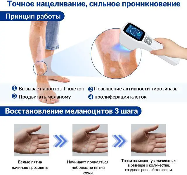 Alt view image 4 of 7 - Toponechoice 308 nm uv light good for skin remedy for white patches on skin back of throat white spots