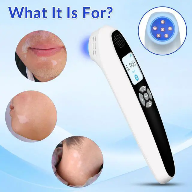 Alt view image 4 of 7 - Toponechoice 308 nm lichen planus ultraviolet light therapy dermatologist uv treatment white patches on fingernails, lip, gum