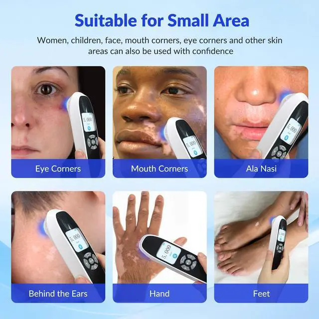 Alt view image 3 of 7 - Toponechoice at home uv light good from sun for psoriasis, vitiligo on hands, white spot under fingernail