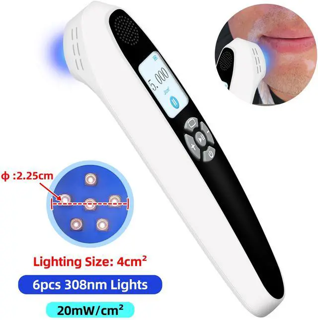 Main image of Toponechoice home narrow band uvb light therapy for vitiligo, white spots on teeth reddit, back of throat white spots