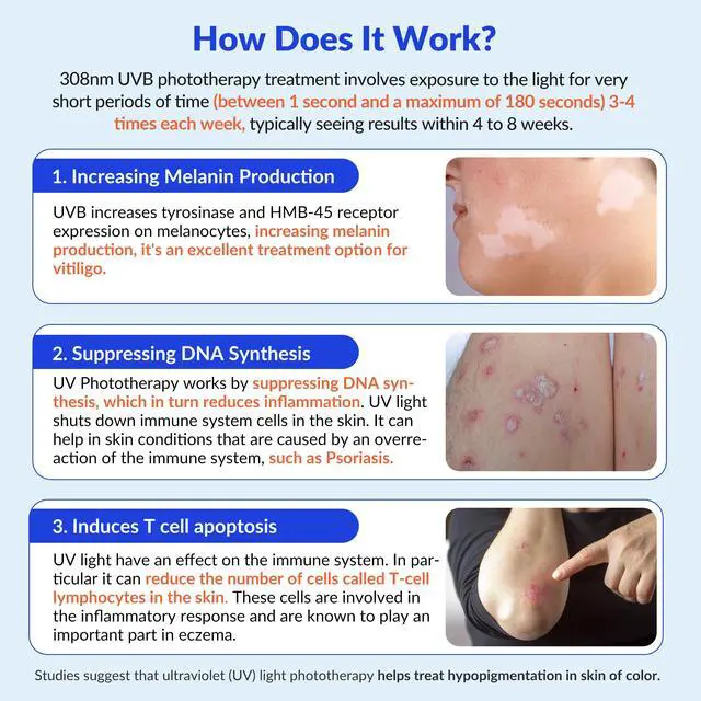 Alt view image 6 of 7 - Toponechoice uv light treatment near me for white spots on skin after sun, on legs