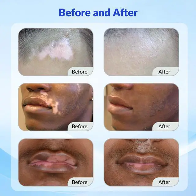 Alt view image 3 of 7 - Toponechoice uv light for skin treatment, cure for white spots on face, white patches in groin area female