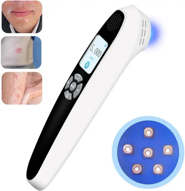 Main image of Toponechoice dermatologist uv treatment for vitiligo white discoloration on nails, white patches at back of throat