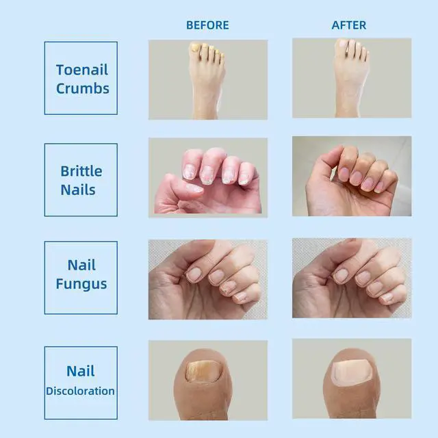 Alt view image 4 of 7 - Toponechoice Liquid Crystal Nail Fungus Phototherapy Device Smart Ultraviolet Fungal Phototherapy Lamp Portable Sterilising Phototherapy Instrument