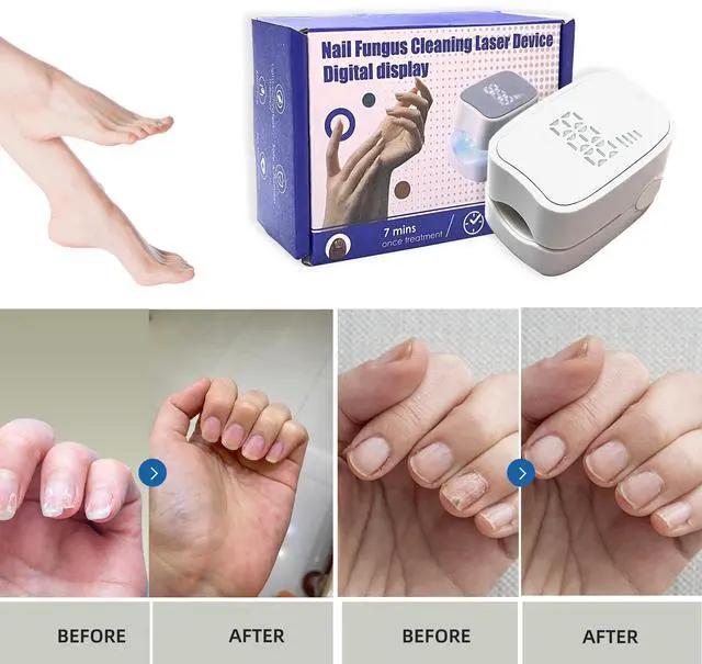 Main image of Toponechoice Liquid Crystal Nail Fungus Phototherapy Device Smart Ultraviolet Fungal Phototherapy Lamp Portable Sterilising Phototherapy Instrument