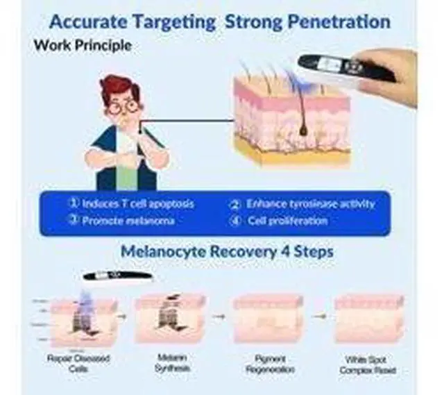 Alt view image 2 of 7 - ZJZK Excimer 308nm Laser Ultraviolet Handheld for Vitiligo, psoriasis