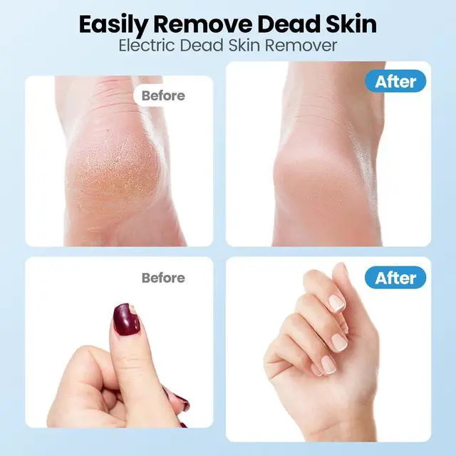Alt view image 6 of 7 - 2-in-1 Electric Callus Remover for Feet, Professional Pedicure Tools Gift
