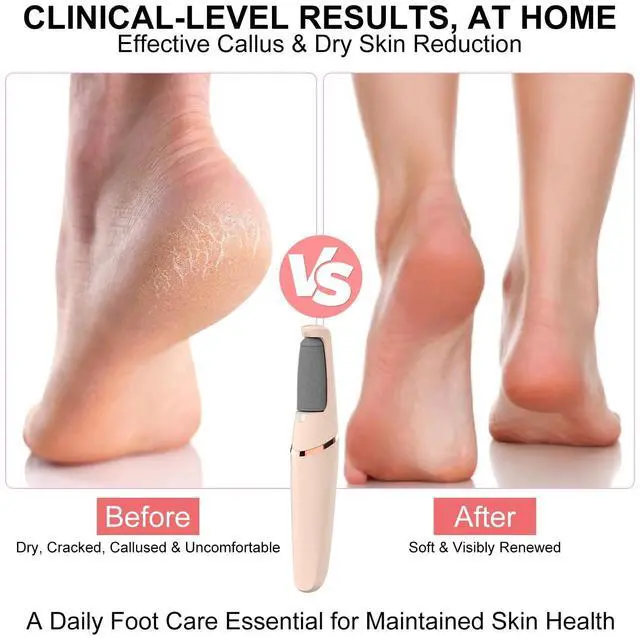 Alt view image 2 of 7 - Electric Foot File, Callus Remover for Feet - Rechargeable Pedicure Tool, 2 Speeds 1700/2000 RPM & 2 Heads for Dry & Dead Cracked Skin, Cordless Waterproof Hard Skin Removal, Home Pedicure Gift