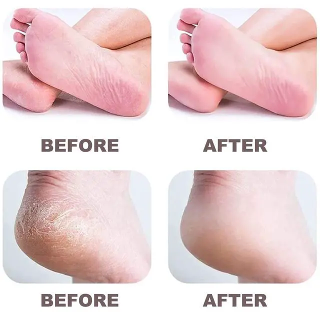 Alt view image 7 of 7 - Electric Callus Remover for Feet with Rechargeable Waterproof Professional Pedicure Kit,Foot Care Tools Wet & Dry Foot File for Dead Skin