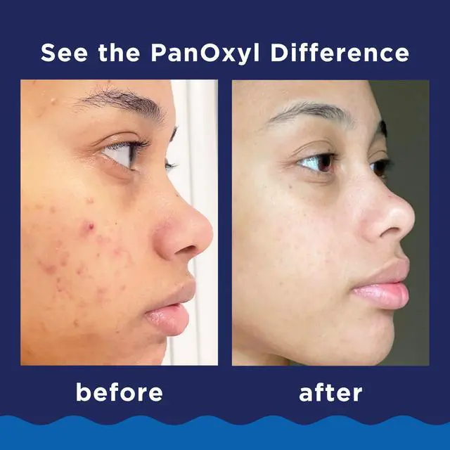 Alt view image 4 of 7 - 10% Benzoyl Peroxide Acne Foaming Wash, Maximum Strength, Daily Acne-Fighting Face and Body Cleanser, Face Wash to Clear, Treat and Prevent Acne Pimples and Stubborn Breakouts, 5.5 Oz Tube