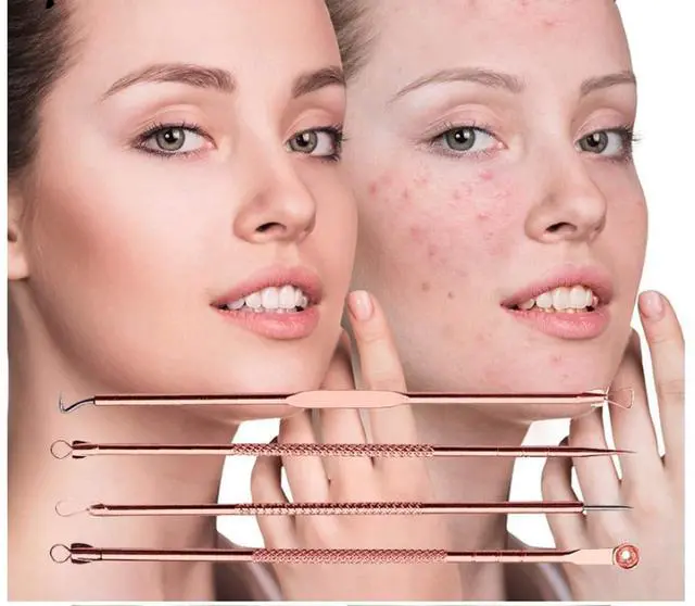 Alt view image 2 of 6 - Blackhead Remover Pimple Comedone Extractor Tool Best Acne Removal Kit - Treatment for Blemish, Whitehead Popping, Zit Removing for Risk Free Nose Face Skin with Case (Rose, 4 Piece Set)