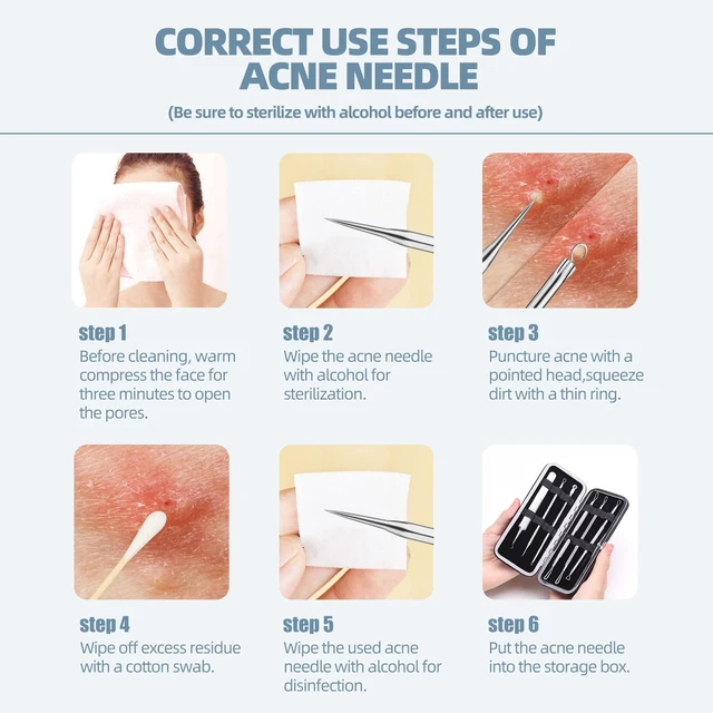 Alt view image 6 of 6 - JPNK Blackhead Remover Comedone Extractor Acne Removal Kit