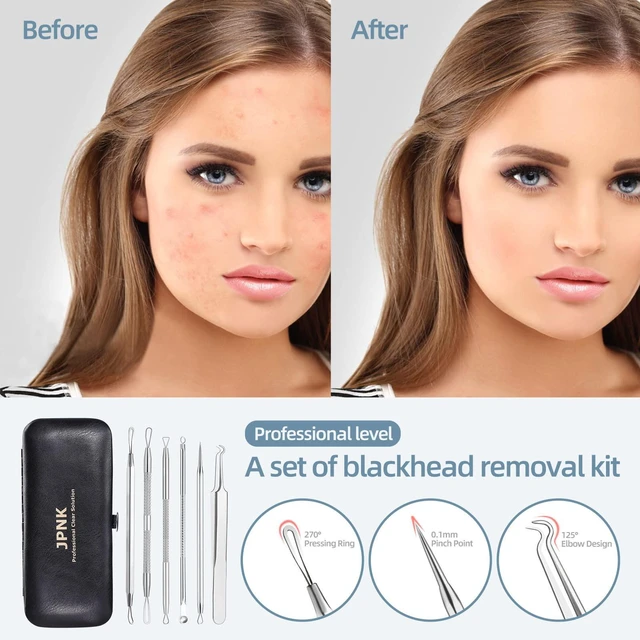 Alt view image 3 of 6 - JPNK Blackhead Remover Comedone Extractor Acne Removal Kit