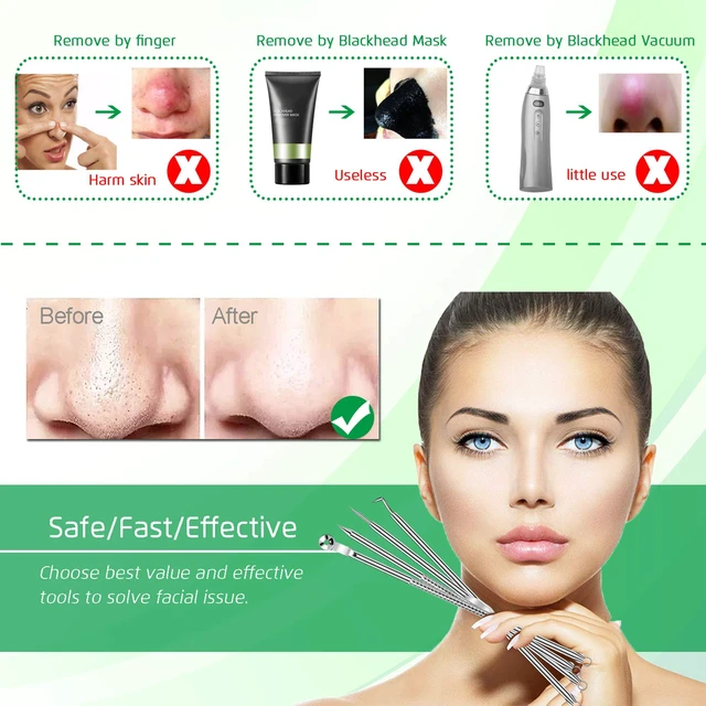 Alt view image 3 of 7 - 5Pcs Stainless Steel Blackhead Remover Comedone Extractor, Curved Tweezers Kit, Professional Acne Blemish Removal Tools