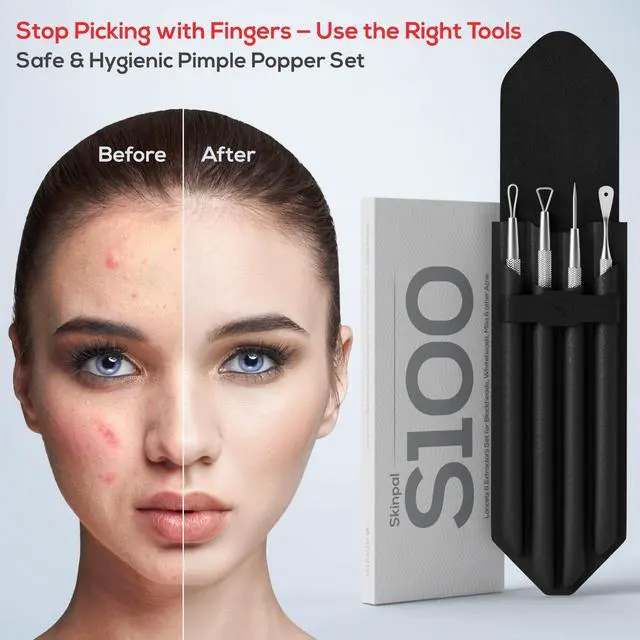 Alt view image 6 of 7 - Pimple Popper Tool Kit & Milia Remover, 4-Piece Stainless Steel Blackhead Extractor, Whitehead & Comedone Extractor with Lancets for Facial Extraction