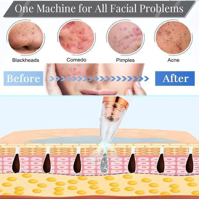 Alt view image 6 of 7 - Blackhead Remover Vacuum, Black Head Remover for Face, Blackhead Extractor with 3 Suction Power, 6 Suction Probes, 4 pcs Pimple Popper Tool Kit, USB Interface Type Pore Vacuum