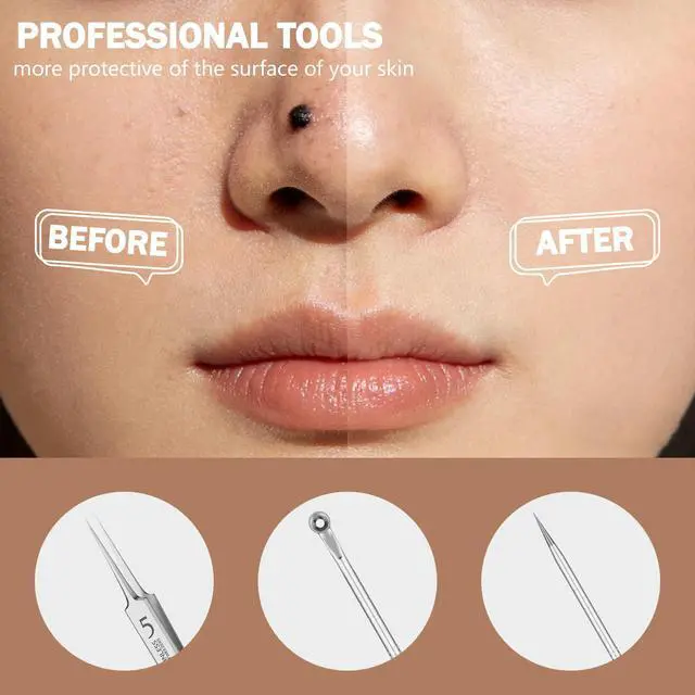 Alt view image 4 of 7 - Blackhead Remover Pimple Popper Tool Kit 10 Pcs Blackhead Remover Tools Kit with Storage Case Pimple Popper Tool kit for Face Nose Deep Cleansing Pimple Extractor for Quick and Easy Removal of Pimples