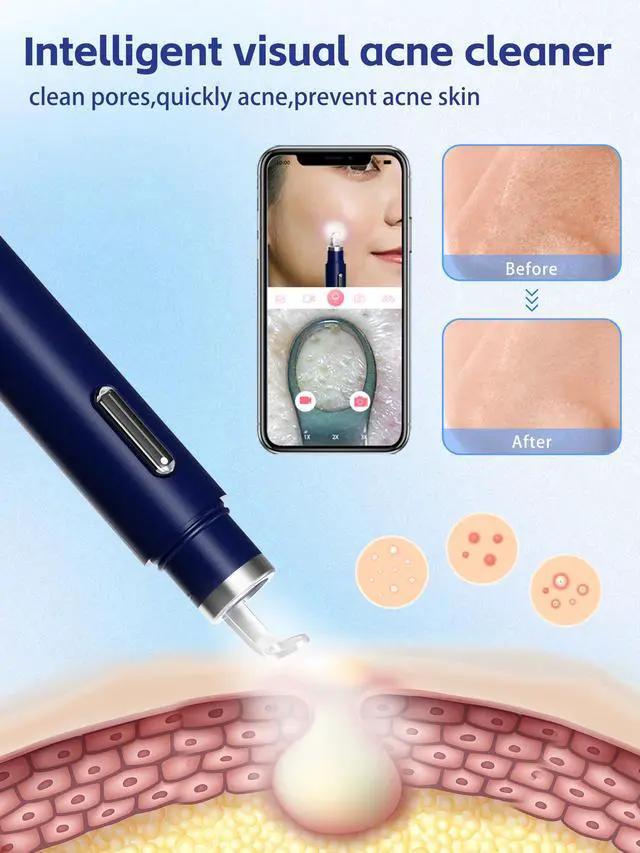 Alt view image 3 of 7 - Visual Blackhead Remover Tools with Camera,Pimple Popper Extractor Tool Kit with Camera 20X 1080P Pore Cleaner Acne Comedone Whitehead Extractor Kit for iPhone/Android (Blue)